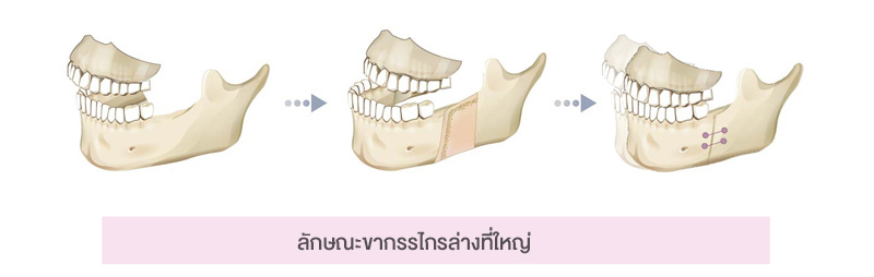 จัดฟันเริ่มอายุเท่าไรดี_2